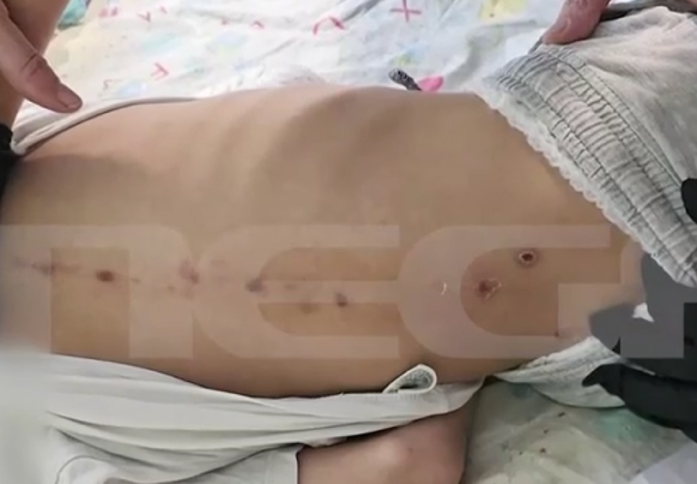 Εγκαύματα τριβής ή κακοποίηση: Αντιπαράθεση για τα σημάδια στο σώμα του 10χρονου ΑμεΑ στην Πάτρα