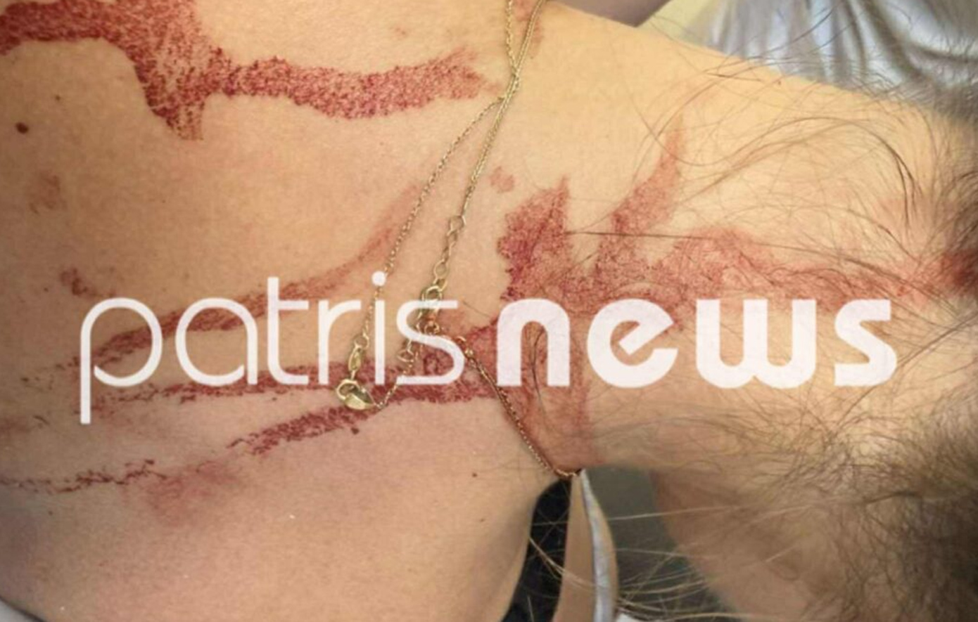 Άγρια επίθεση γυναικών στην Αμαλιάδα: Την κυνηγούσε με ψαλίδι στον δρόμο και της το καρφώθηκε στην πλάτη