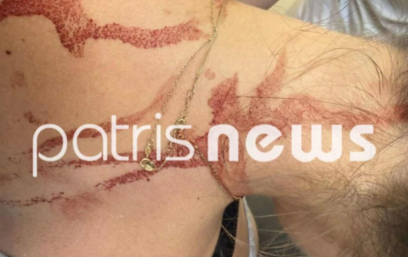 Στη φυλακή η 48χρονη που μαχαίρωσε γυναίκα με ψαλίδι στην πλάτη