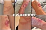 Πήγαν για μπάνιο σε παραλία της Χαλκίδας και βγήκαν από τη θάλασσα γεμάτες μυστηριώδη σημάδια