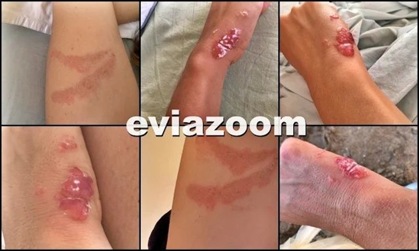 Πήγαν για μπάνιο σε παραλία της Χαλκίδας και βγήκαν από τη θάλασσα γεμάτες μυστηριώδη σημάδια