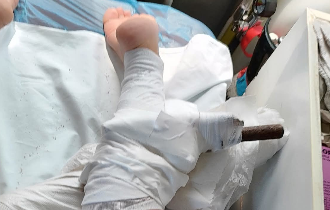 26χρονη στη Χαλκιδική τραυματίστηκε από ομπρέλα: «Θύμα» των δυνατών ανέμων στην παραλία