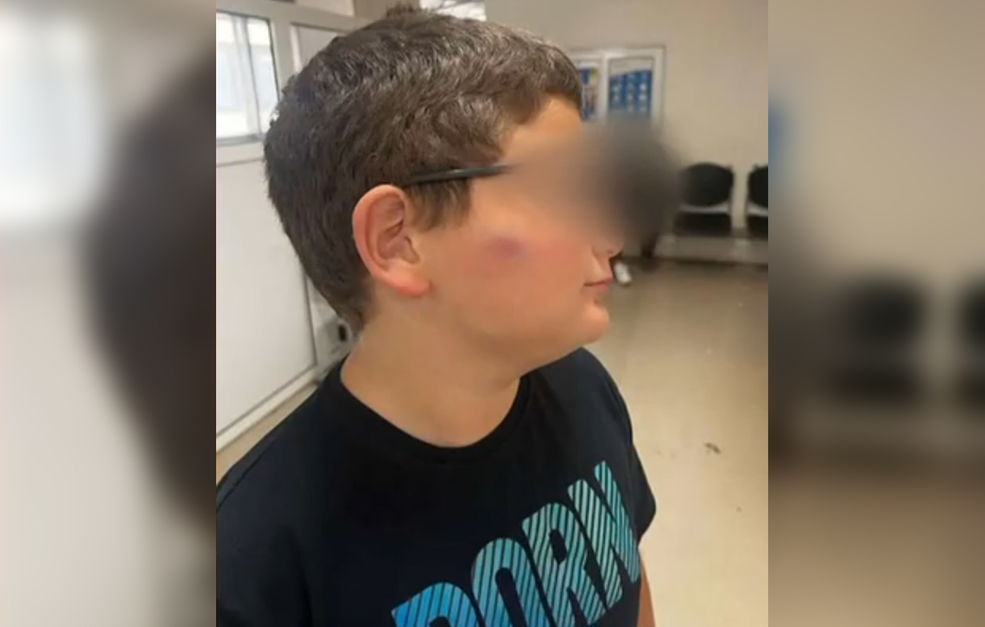 11χρονος στη Θεσσαλονίκη δέχθηκε άγρια επίθεση bullying από συμμαθητές στο σχολικό προαύλιο