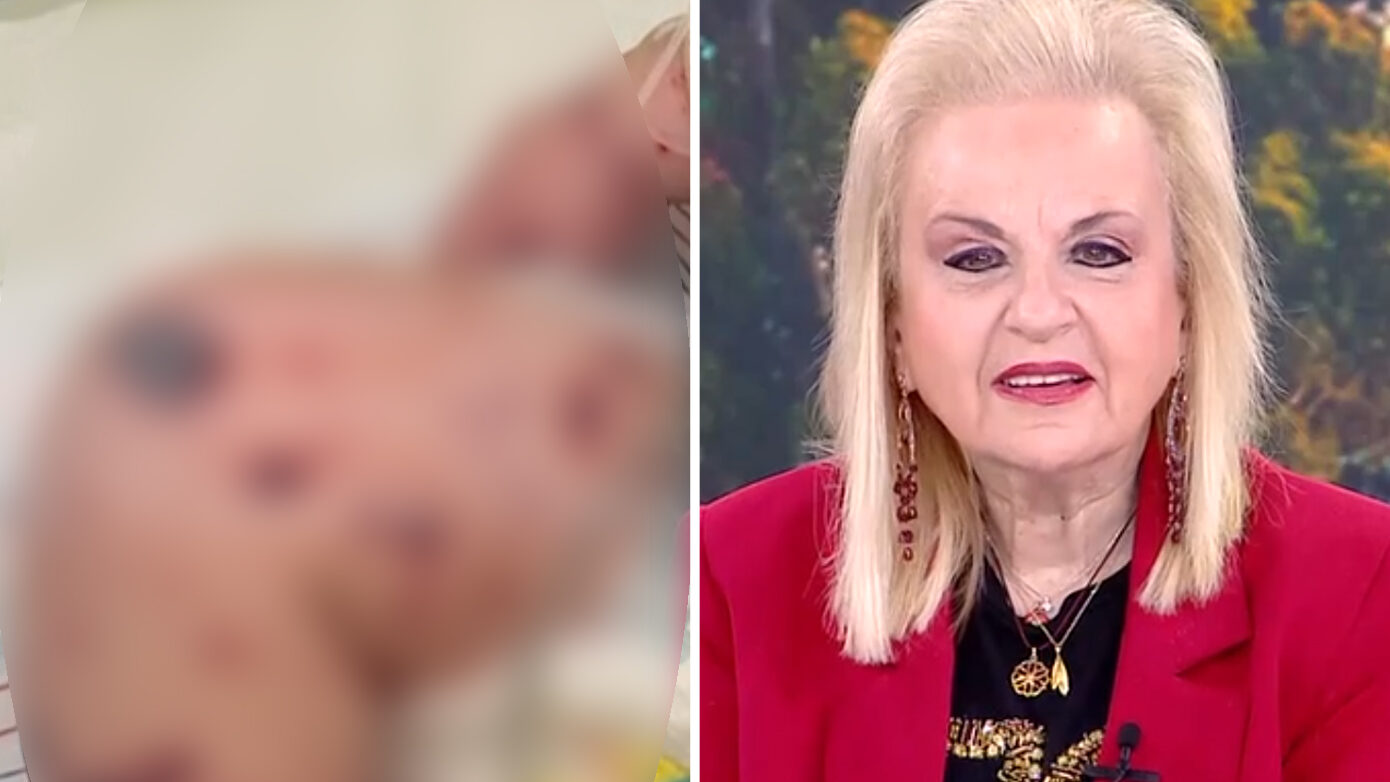 Παγώνη για το βρέφος στη Ζάκυνθο: Δεν καταγράφουμε θανάτους από ιογενή μηνιγγίτιδα – Οι φωτογραφίες δεν αρκούν για διαγνώσεις