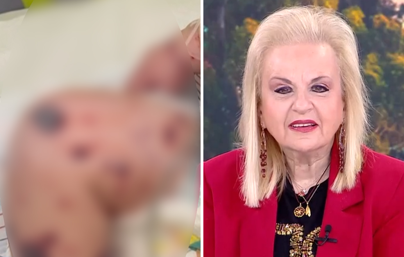 Παγώνη για το βρέφος στη Ζάκυνθο: Δεν καταγράφουμε θανάτους από ιογενή μηνιγγίτιδα – Οι φωτογραφίες δεν αρκούν για διαγνώσεις