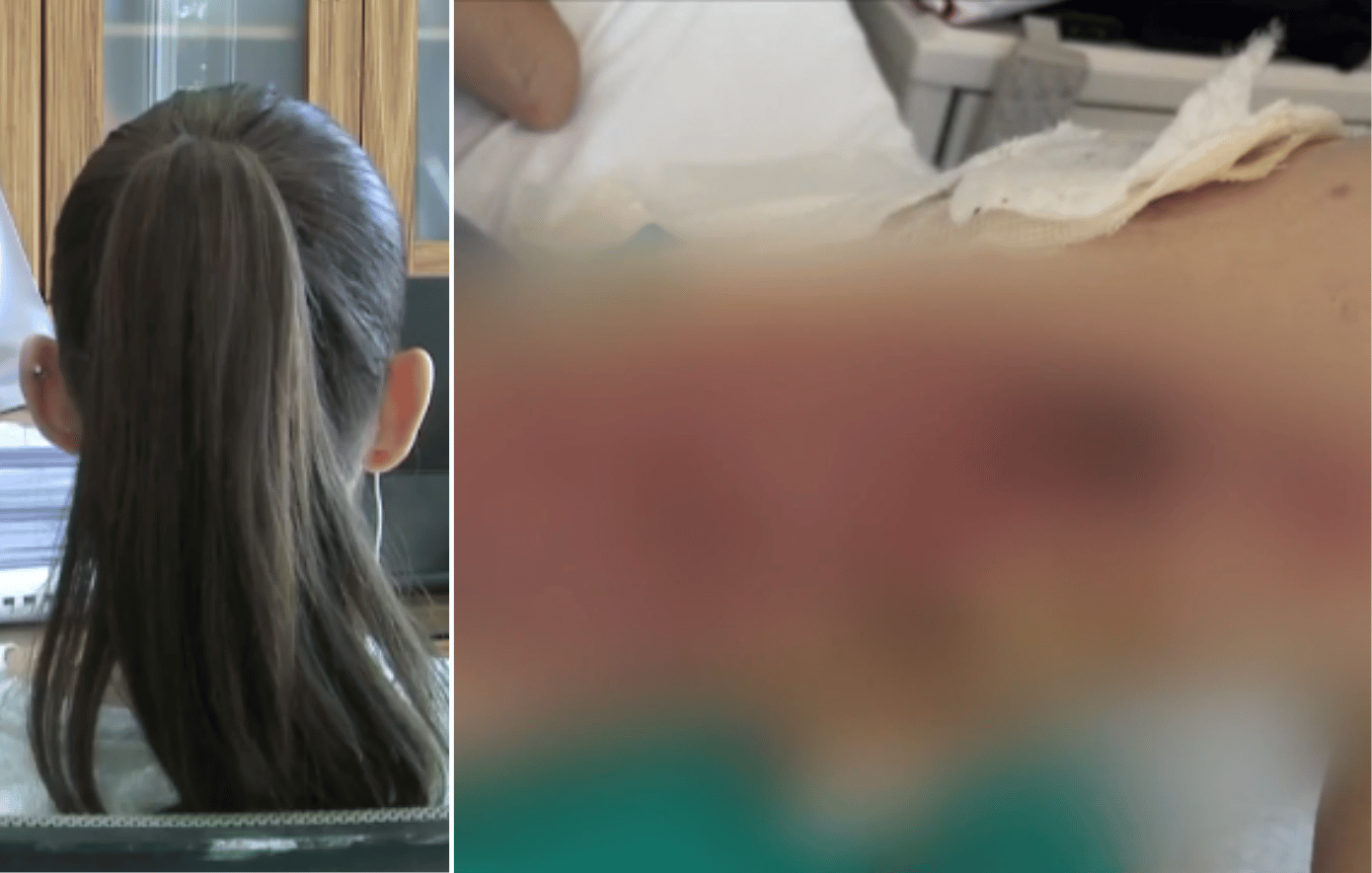 Θεσσαλονίκη: Η 20χρονη εγκαυματίας περιγράφει ότι ο γιατρός της έριξε υγρό και άρχισε να καίγεται αφόρητα